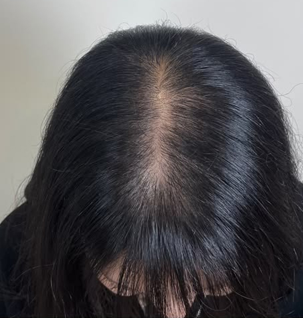 Después del injerto femenino