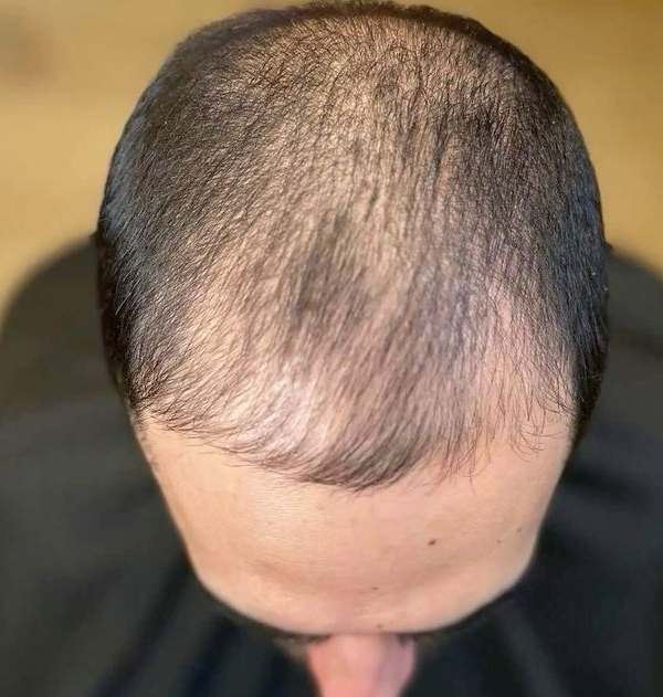 Después del injerto de cabello