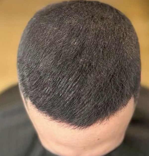 Antes del injerto de cabello